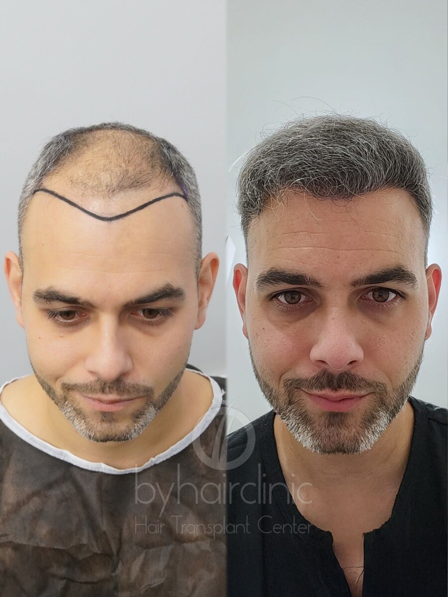 Trait rasoir cheveux guide